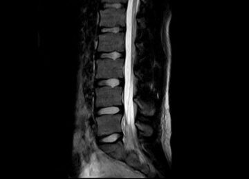 Risonanza magnetica aperta lombare