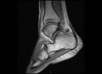 Risonanza magnetica aperta al piede e alla caviglia