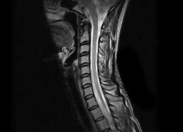 Risonanza magnetica aperta alla cervicale