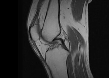 Risonanza magnetica aperta al ginocchio